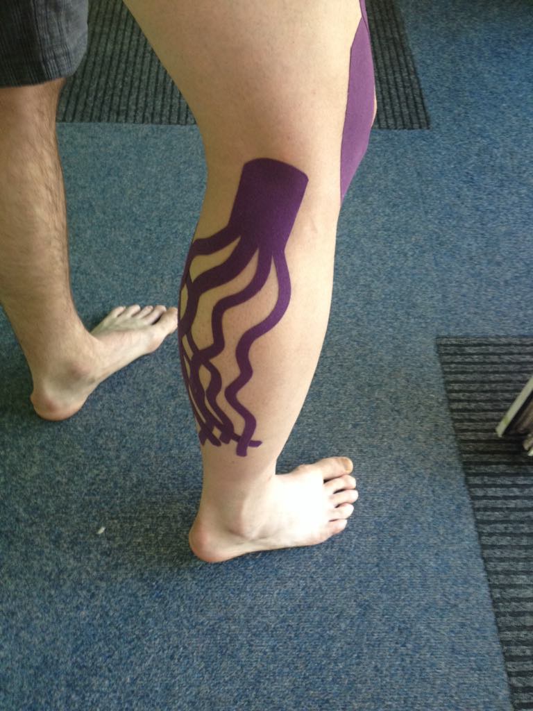 Kineziotaping