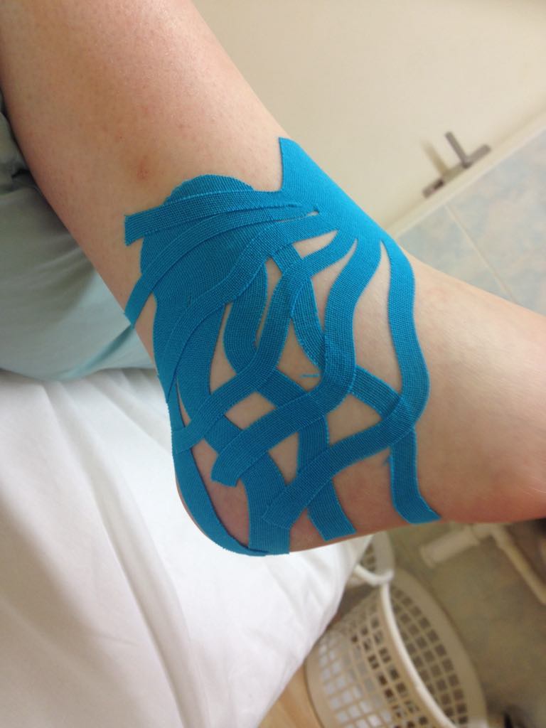 Kineziotaping